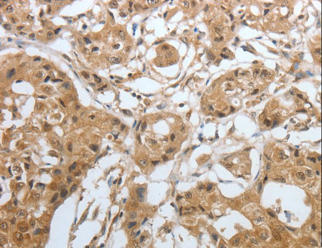 AMPH / Amphiphysin Antibody - Immunohistochemistry of paraffin-embedded Human lung cancer using AMPH Polyclonal Antibody at dilution of 1:30.