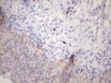 AMTN Antibody - Immunohistochemical staining of paraffin-embedded Carcinoma of Human prostate tissue using anti-AMTN mouse monoclonal antibody. (Heat-induced epitope retrieval by 1mM EDTA in 10mM Tris buffer. (pH8.5) at 120 oC for 3 min. (1:150)