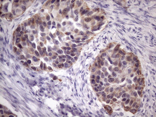AMTN Antibody - Immunohistochemical staining of paraffin-embedded Carcinoma of Human kidney tissue using anti-AMTN mouse monoclonal antibody. (Heat-induced epitope retrieval by 1mM EDTA in 10mM Tris buffer. (pH8.5) at 120 oC for 3 min. (1:150)