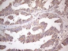 AMTN Antibody - Immunohistochemical staining of paraffin-embedded Adenocarcinoma of Human ovary tissue using anti-AMTN mouse monoclonal antibody. (Heat-induced epitope retrieval by 1mM EDTA in 10mM Tris buffer. (pH8.5) at 120°C for 3 min. (1:150)