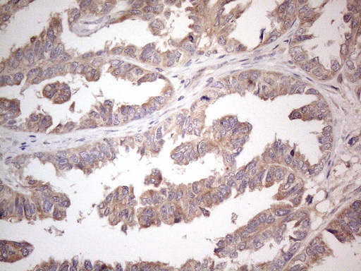 AMTN Antibody - Immunohistochemical staining of paraffin-embedded Adenocarcinoma of Human ovary tissue using anti-AMTN mouse monoclonal antibody. (Heat-induced epitope retrieval by 1mM EDTA in 10mM Tris buffer. (pH8.5) at 120°C for 3 min. (1:150)