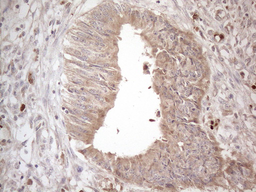 AMTN Antibody - Immunohistochemical staining of paraffin-embedded Adenocarcinoma of Human colon tissue using anti-AMTN mouse monoclonal antibody. (Heat-induced epitope retrieval by 1mM EDTA in 10mM Tris buffer. (pH8.5) at 120°C for 3 min. (1:150)
