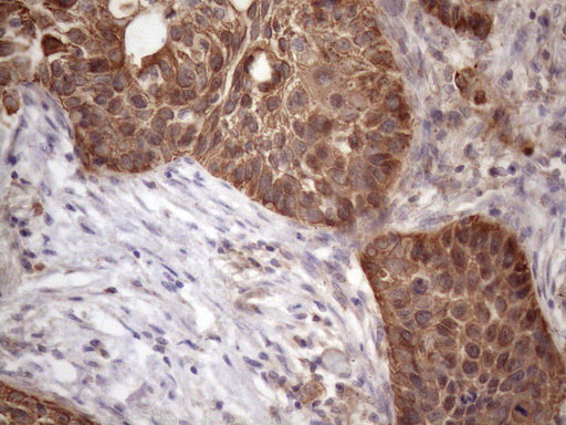 AMTN Antibody - Immunohistochemical staining of paraffin-embedded Carcinoma of Human lung tissue using anti-AMTN mouse monoclonal antibody. (Heat-induced epitope retrieval by 1mM EDTA in 10mM Tris buffer. (pH8.5) at 120 oC for 3 min. (1:150)