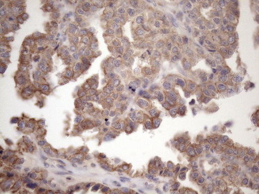 AMTN Antibody - Immunohistochemical staining of paraffin-embedded Adenocarcinoma of Human ovary tissue using anti-AMTN mouse monoclonal antibody. (Heat-induced epitope retrieval by 1mM EDTA in 10mM Tris buffer. (pH8.5) at 120 oC for 3 min. (1:150)