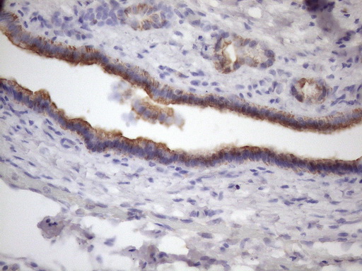 AMTN Antibody - Immunohistochemical staining of paraffin-embedded Carcinoma of Human pancreas tissue using anti-AMTN mouse monoclonal antibody. (Heat-induced epitope retrieval by 1mM EDTA in 10mM Tris buffer. (pH8.5) at 120 oC for 3 min. (1:150)