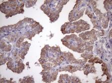 AMTN Antibody - Immunohistochemical staining of paraffin-embedded Carcinoma of Human thyroid tissue using anti-AMTN mouse monoclonal antibody. (Heat-induced epitope retrieval by 1mM EDTA in 10mM Tris buffer. (pH8.5) at 120 oC for 3 min. (1:150)