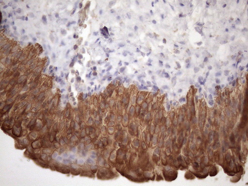 AMTN Antibody - Immunohistochemical staining of paraffin-embedded Carcinoma of Human prostate tissue using anti-AMTN mouse monoclonal antibody. (Heat-induced epitope retrieval by 1mM EDTA in 10mM Tris buffer. (pH8.5) at 120 oC for 3 min. (1:150)