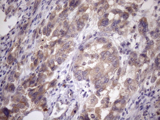 AMTN Antibody - Immunohistochemical staining of paraffin-embedded Adenocarcinoma of Human endometrium tissue using anti-AMTN mouse monoclonal antibody. (Heat-induced epitope retrieval by Tris-EDTA, pH8.0)(1:150)