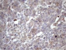 AMTN Antibody - Immunohistochemical staining of paraffin-embedded Adenocarcinoma of Human ovary tissue using anti-AMTN mouse monoclonal antibody. (Heat-induced epitope retrieval by Tris-EDTA, pH8.0)(1:150)