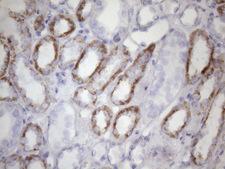 AMTN Antibody - Immunohistochemical staining of paraffin-embedded Carcinoma of Human lung tissue using anti-AMTN mouse monoclonal antibody. (Heat-induced epitope retrieval by 1mM EDTA in 10mM Tris buffer. (pH8.5) at 120 oC for 3 min. (1:150)
