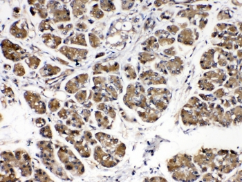 AMY1A / Salivary Amylase Antibody - IHC testing of human pancreatic cancer tissue with Alpha Amylase antibody at 0.5ug/ml. Required HIER: steam section in pH6 citrate buffer for 20 min and allow to cool prior to testing.