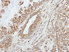 AMY2A / Pancreatic Amylase Antibody - IHC of paraffin-embedded OVCA using alpha amylase 2A (pancreatic) antibody at 1:500 dilution.