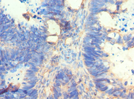 AMY2A / Pancreatic Amylase Antibody - Immunohistochemistry of paraffin-embedded human ovarian cancer using antibody at 1:100 dilution.