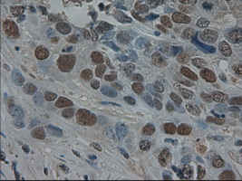 AMY2A / Pancreatic Amylase Antibody - IHC of paraffin-embedded Adenocarcinoma of breast using anti-AMY2A mouse monoclonal antibody.