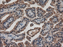 AMY2A / Pancreatic Amylase Antibody - IHC of paraffin-embedded Carcinoma of kidney using anti-AMY2A mouse monoclonal antibody.