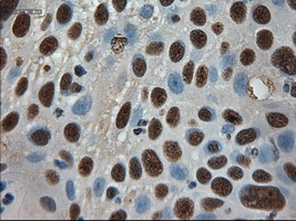 AMY2A / Pancreatic Amylase Antibody - IHC of paraffin-embedded Carcinoma of lung using anti-AMY2A mouse monoclonal antibody.