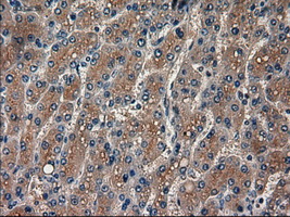 AMY2A / Pancreatic Amylase Antibody - IHC of paraffin-embedded Carcinoma of liver using anti-AMY2A mouse monoclonal antibody.