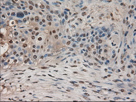 AMY2A / Pancreatic Amylase Antibody - IHC of paraffin-embedded Carcinoma of pancreas using anti-AMY2A mouse monoclonal antibody.