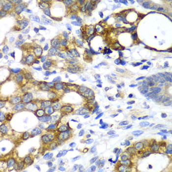 AMY2A / Pancreatic Amylase Antibody - Immunohistochemistry of paraffin-embedded human gastric cancer tissue.