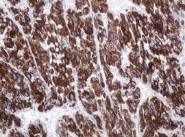 AMY2B Antibody - IHC of paraffin-embedded Carcinoma of Human liver tissue using anti-AMY2B mouse monoclonal antibody.
