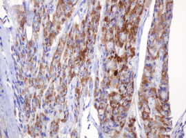 AMY2B Antibody - IHC of paraffin-embedded Carcinoma of Human thyroid tissue using anti-AMY2B mouse monoclonal antibody.