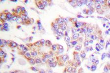 ANAPC1 / APC1 Antibody - IHC of APC1 (E684) pAb in paraffin-embedded human breast carcinoma tissue.