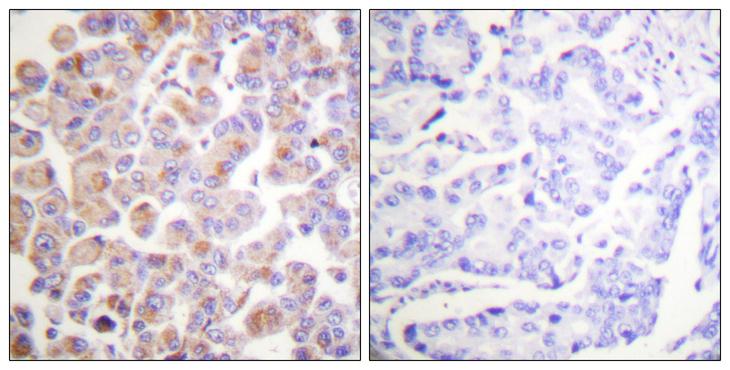 ANAPC1 / APC1 Antibody - Peptide - + Immunohistochemistry analysis of paraffin-embedded human breast carcinoma tissue using APC1 antibody.