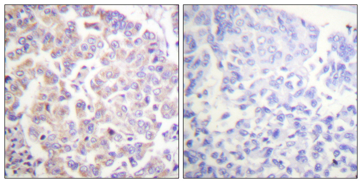 ANAPC1 / APC1 Antibody - Immunohistochemistry analysis of paraffin-embedded human breast carcinoma, using APC1 (Phospho-Ser688) Antibody. The picture on the right is blocked with the phospho peptide.