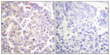 ANAPC1 / APC1 Antibody - P-peptide - + Immunohistochemistry analysis of paraffin-embedded human breast carcinoma tissue using APC1 (Phospho-Ser688) antibody.