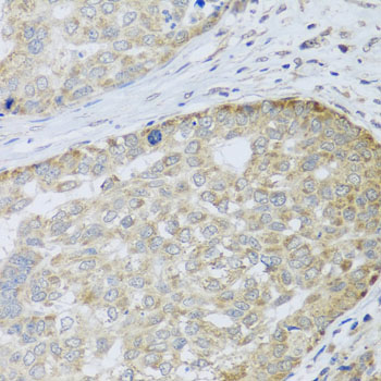 ANAPC10 / APC10 Antibody - Immunohistochemistry of paraffin-embedded human liver cancer tissue.