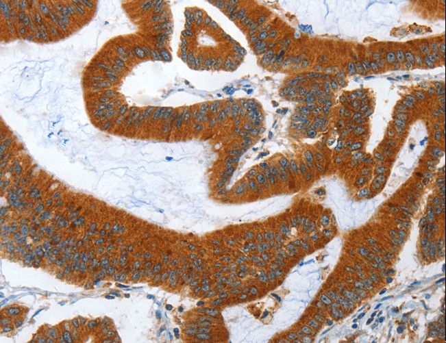 ANAPC10 / APC10 Antibody - Immunohistochemistry of paraffin-embedded Human lung cancer using ANAPC10 Polyclonal Antibody at dilution of 1:40.