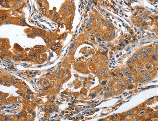 ANAPC10 / APC10 Antibody - Immunohistochemistry of paraffin-embedded Human lung cancer using ANAPC10 Polyclonal Antibody at dilution of 1:40.