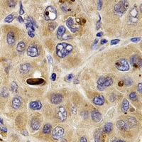 ANAPC10 / APC10 Antibody - Immunohistochemical analysis of APC10 staining in human liver cancer formalin fixed paraffin embedded tissue section. The section was pre-treated using heat mediated antigen retrieval with sodium citrate buffer (pH 6.0). The section was then incubated with the antibody at room temperature and detected using an HRP conjugated compact polymer system. DAB was used as the chromogen. The section was then counterstained with hematoxylin and mounted with DPX.