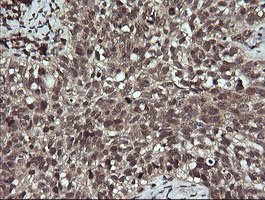 ANAPC11 / APC11 Antibody - IHC of paraffin-embedded Carcinoma of Human lung tissue using anti-ANAPC11 mouse monoclonal antibody. (Heat-induced epitope retrieval by 10mM citric buffer, pH6.0, 120°C for 3min).
