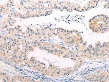 ANAPC15 Antibody - Immunohistochemistry of paraffin-embedded Human liver cancer tissue  using ANAPC15 Polyclonal Antibody at dilution of 1:50(×200)