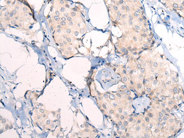 ANAPC15 Antibody - Immunohistochemistry of paraffin-embedded Human breast cancer tissue  using ANAPC15 Polyclonal Antibody at dilution of 1:50(×200)