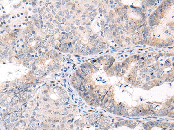ANAPC15 Antibody - Immunohistochemistry of paraffin-embedded Human ovarian cancer tissue  using ANAPC15 Polyclonal Antibody at dilution of 1:70(×200)