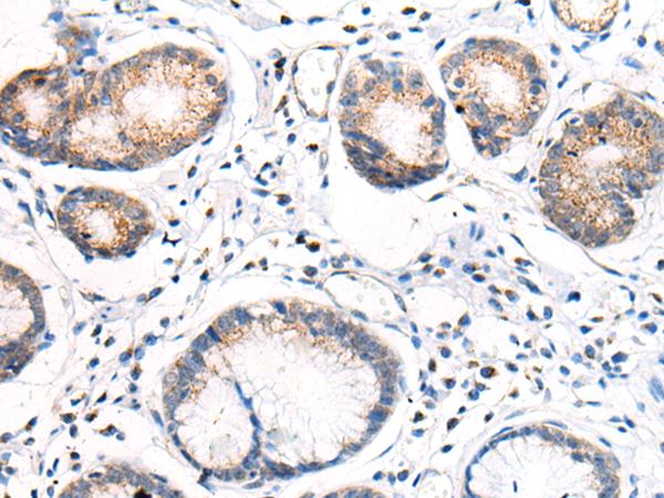 ANAPC15 Antibody - Immunohistochemistry of paraffin-embedded Human gastric cancer tissue  using ANAPC15 Polyclonal Antibody at dilution of 1:70(×200)