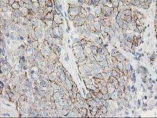 ANAPC2 / APC2 Antibody - IHC of paraffin-embedded Adenocarcinoma of Human breast tissue using anti-ANAPC2 mouse monoclonal antibody.
