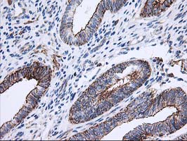 ANAPC2 / APC2 Antibody - IHC of paraffin-embedded Adenocarcinoma of Human endometrium tissue using anti-ANAPC2 mouse monoclonal antibody.