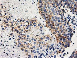 ANAPC2 / APC2 Antibody - IHC of paraffin-embedded Carcinoma of Human bladder tissue using anti-ANAPC2 mouse monoclonal antibody.