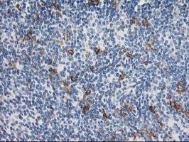 ANAPC2 / APC2 Antibody - IHC of paraffin-embedded Human lymphoma tissue using anti-ANAPC2 mouse monoclonal antibody.