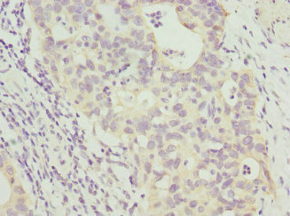 ANAPC2 / APC2 Antibody - Immunohistochemistry of paraffin-embedded human bladder cancer at dilution 1:100