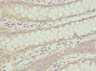 ANAPC2 / APC2 Antibody - Immunohistochemistry of paraffin-embedded human colon cancer at dilution 1:100