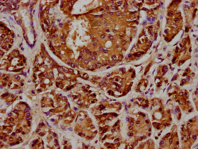 ANAPC2 / APC2 Antibody - IHC image of ANAPC2 Antibody diluted at 1:348 and staining in paraffin-embedded human pancreatic cancer performed on a Leica BondTM system. After dewaxing and hydration, antigen retrieval was mediated by high pressure in a citrate buffer (pH 6.0). Section was blocked with 10% normal goat serum 30min at RT. Then primary antibody (1% BSA) was incubated at 4°C overnight. The primary is detected by a biotinylated secondary antibody and visualized using an HRP conjugated SP system.