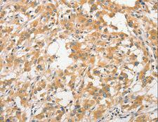 ANAPC5 / APC5 Antibody - Immunohistochemistry of paraffin-embedded Human liver cancer using ANAPC5 Polyclonal Antibody at dilution of 1:30.