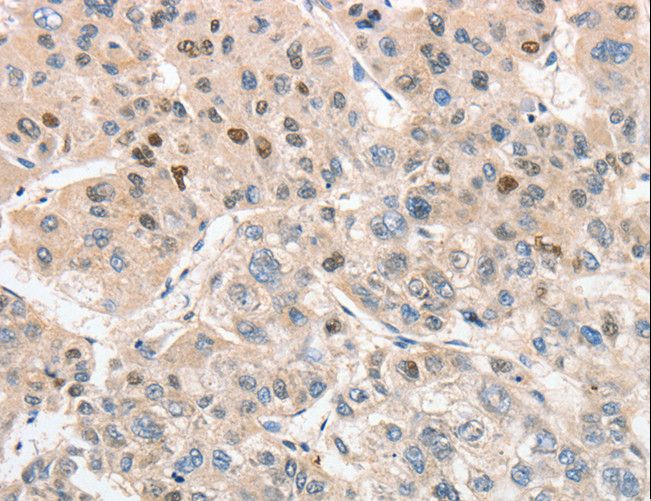 ANAPC5 / APC5 Antibody - Immunohistochemistry of paraffin-embedded Human liver cancer using ANAPC5 Polyclonal Antibody at dilution of 1:30.