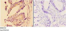 Angiogenin / ANG Antibody - Immunohistochemistry (IHC) analysis of ANG antibody in paraffin-embedded human rectum carcinoma tissue at 1:50, showing cell membrane and secreted staining. Negative control (the right) using PBS instead of primary antibody. Secondary antibody is Goat Anti-Rabbit.