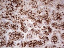 ANGPT1 / Angiopoietin-1 Antibody - IHC of paraffin-embedded Carcinoma of Human liver tissue using anti-ANGPT1 mouse monoclonal antibody. (Heat-induced epitope retrieval by 1 mM EDTA in 10mM Tris, pH8.5, 120°C for 3min).