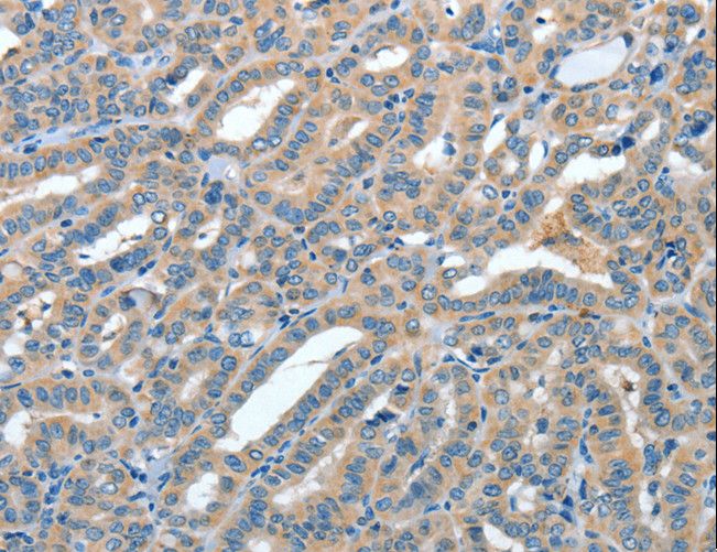 ANGPT1 / Angiopoietin-1 Antibody - Immunohistochemistry of paraffin-embedded Human colon cancer using ANGPT1 Polyclonal Antibody at dilution of 1:50.